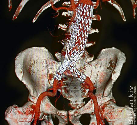 EVAR-graft