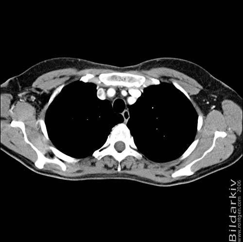 Thorax 13