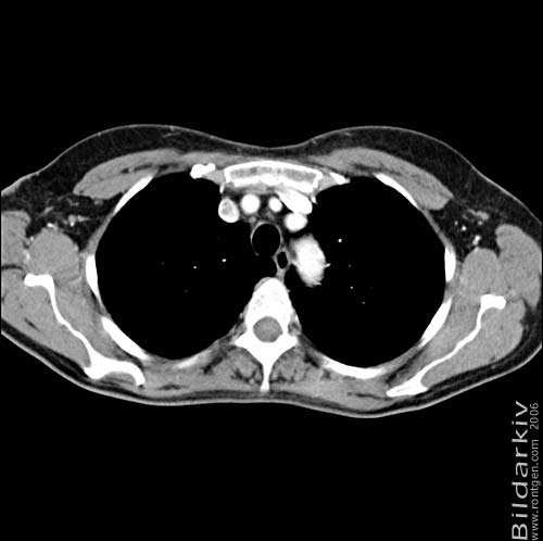 Thorax 14