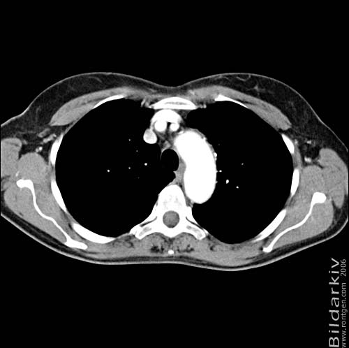 Thorax 17