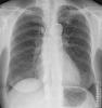 25a lungorna kvinna 81 r