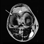 MR knäled meniskruptur