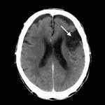 CT-hjärna infarkt