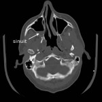 CT sinus