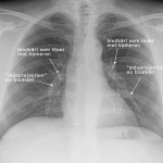 Lungröntgen