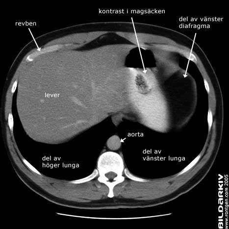 Tumor i ryggen symptomer