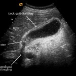 Ultraljud cholecystit