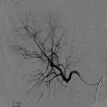 Angiografi