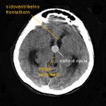 CT-skalle colloid cysta