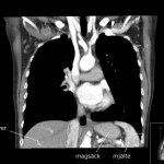 CT-thorax med kontrast