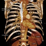 CT-thorax 3D