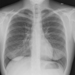 Lungröntgen mjukdelar 121kV