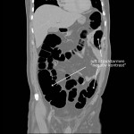 CT-colon med luft (negativ kontrast) i tarmen
