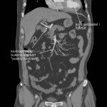 CT-buk med positiv kontrastmedel