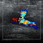 Ultraljud pseudoaneurysm vänster ljumskärl