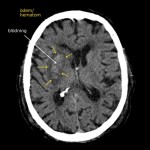 CT-skalle med blödning och ödem