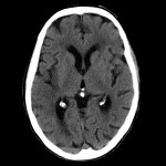 CT-skalle misstänkt infarkt