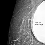 Bröstimplantat av silikon bakom muskeln