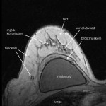 MR-bröst med implantat (bild Internet)