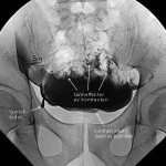 Herniografi