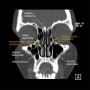 CT sinus