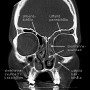 SinuitCT sinus