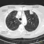 CT-lungor med kontrast tumör