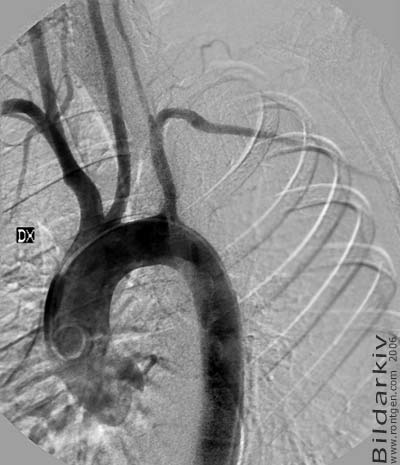Aortabgen