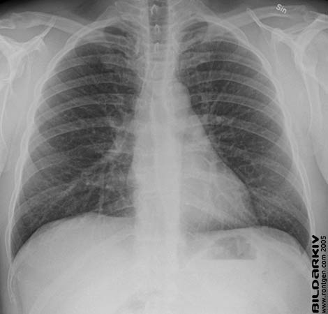 12a Lungorna man 34 �r