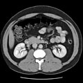 CT urinvägar