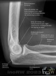 Röntgen armbåge sidobild
