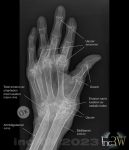 Hand reumatoid artrit med erosion och luxationer