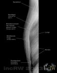 Röntgen av bröstbenet (sternum) sidobild