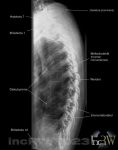 Röntgen bröstryggen sidobild