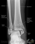 Röntgen fotled med bimalleolär fraktur med leddistortion