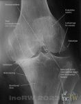 Röntgen knäled med kraftig artros med varusfelställning och medial subluxation