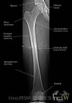 Röntgen lårbenet (femur)