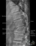 Röntgen ländrygg kompresssionsfraktur typ Chance