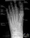 Röntgen Fot frakturer metatarsalbenen dig 2-4