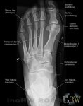 Röntgen fot Hallux valgus (hammartå)