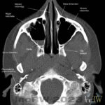 CT-sinus axial bild