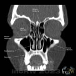 CT-bihålor coronar bild