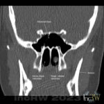 CT-sinus polyp sinus maxillaris