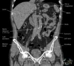 CT-buköversikt coronar bild lågdos