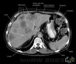 CT-buk levermetastaser