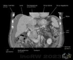 CT-buk coronar bild med kontrast pancreascancer