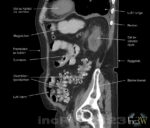 CT-buk sagitel bild divertiklar på tjocktarmen
