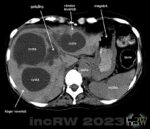 CT-buk levercystor benigna