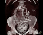 Fosteröversikt 3D CT-buk