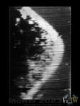Mammografi 1960